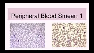 Peripheral Blood Film: 1