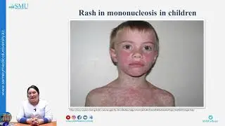 Infectious mononucleosis in children