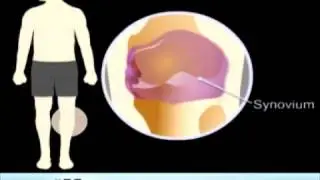 Reasons for a Total Knee Replacement