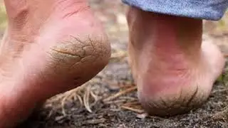 Трещины на пятках
