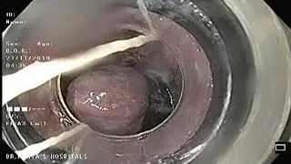 Esophageal banding for esophageal varices