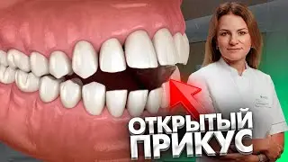 Открытый прикус (Клинический случай)