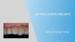 תיקון שבר חרסינה בגשר ישן