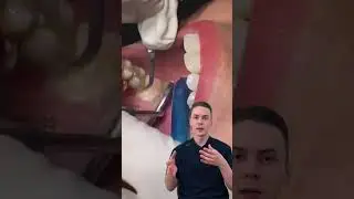 У Вас есть зубной камень?🤨 