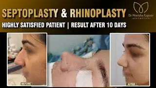 Broad and Wide Nose Rhinoplasty Surgery | Rhinoplasty Nose Before & After | Dr Monisha Kapoor