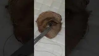 Vertical Mattress Eyelid Tacking