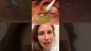 Removing an OBSCENE Number Of Contact Lenses From An Eye - Can You Guess How Many??