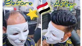 الشبكية الفرنسية وداعا للصلع الوراثي هنكمل الناقص عندك 01150543471