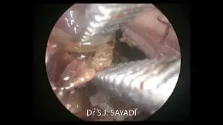 L' Ablation des croûtes  nasales peut donner des épistaxis