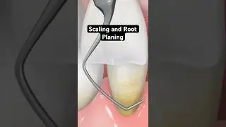 Scaling and root planing (3D Animation)