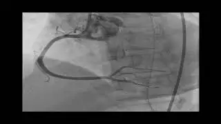 angioplasty1
