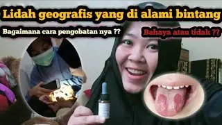 Lidah geografis pada balita (Lidah Berpulau)