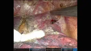 Uniportal Robotic Right upper lobe adhesion takedown