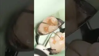 Restauración dental 
