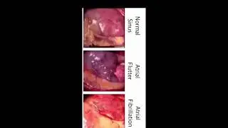 Sinus rhythm, atrial flutter, atrial fibrillation