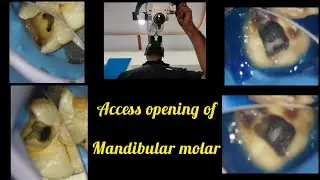 Access opening of Mandibular 1stmolar#rct for beginners# step by step root canal treatment#rctbasics