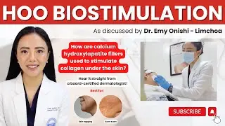 HOO BIOSTIMULATION WITH CALCIUM HYDROXYLAPATITE FILLERS
