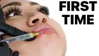 Watch This Before Getting Lip Fillers