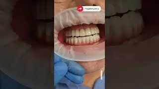 Имплантация. До и после. Implantation