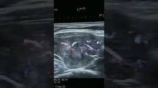 Фолликулярный рак щитовидной железы