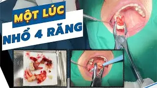 Nhổ 4 răng hàm cùng lúc - Ác mộng 