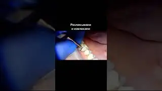 Так снимаются старые керамические коронки 