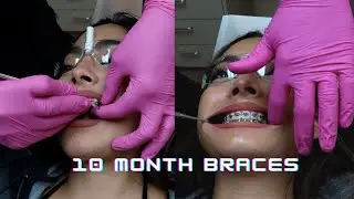 10 MONTH BRACES UPDATE (RUBBER BANDS + MY GAPS ARE ALMOST CLOSED)