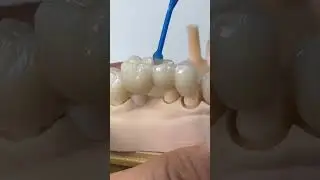 Alternative option for tooth saving!