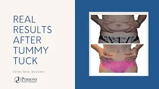 You lost the weight. What about that extra skin? ⤵️⤵️⤵️