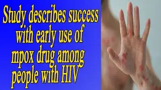 Study describes success with early use of mpox drug among people with HIV