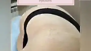 Training: body Lipolysis and lymphatic drainage injections for subcutaneous fat reduction