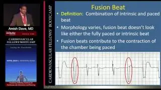 Bradyarrhythmias and Pacemakers (Amish Dave, MD)  Sunday, August 21, 2016