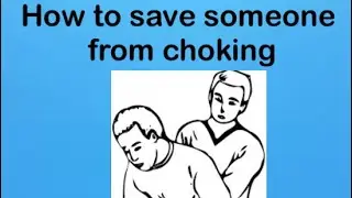 How to perform the Heimlich maneuver