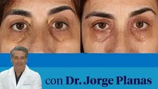 Cómo tratar los xantelasmas