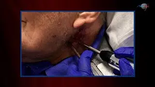 WCW: Using Electrical Stimulation to Treat Wounds