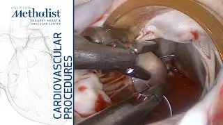 How to Set Up a Minimally Invasive Mitral Valve Surgery: Step by Step (Ramchandani, MD, Al Abri, MD)