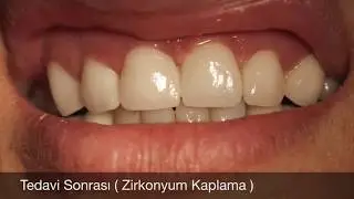 Zirkonyum Kaplama Diş Hekimi Hamza Keskin Öncesi Sonrası