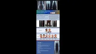SICOT PIONEER : Blount’s Disease: Tips & Tricks