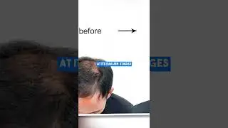 Is ALL Hair Loss Permanent?