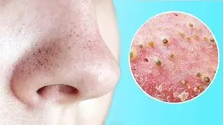 HOW TO GET RID OF BLACKHEADS? 😱😱😱