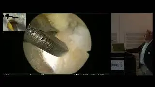 RIWOspine Global Endoscopic Spine Days 2024 - Case presentation by Dr. Peter van Daele