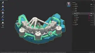 Stackable Guide - Implant 3D Sculpt software