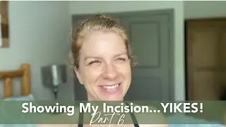 Hysterectomy Experience Part 6   Post Op Day 5