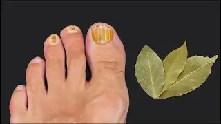How to Eliminate Nail Fungus Quickly and Permanently! 🔥🔥🔥