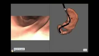 EndoSim Upper GI: Passage of pylorus