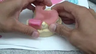 Immediate Denture/RPD Jaw Relationship Record Fabrication
