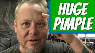 Vlog 353: Huge Pimple