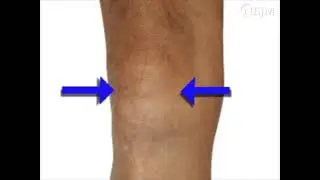 Arthrocentesis of Knee [NEJM]