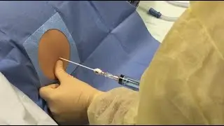 4 Buckets  of fluid removed from abdomen