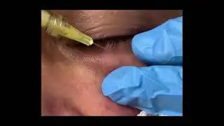 Blanqueamiento y relleno de surcos en ojeras con Nanofat - Medicina Regenerativa